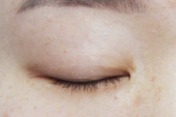 Closed eyelid before incisional double eyelid surgery