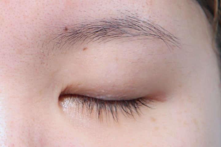 Closed eyelid 3 months after natural adhesion double eyelid surgery