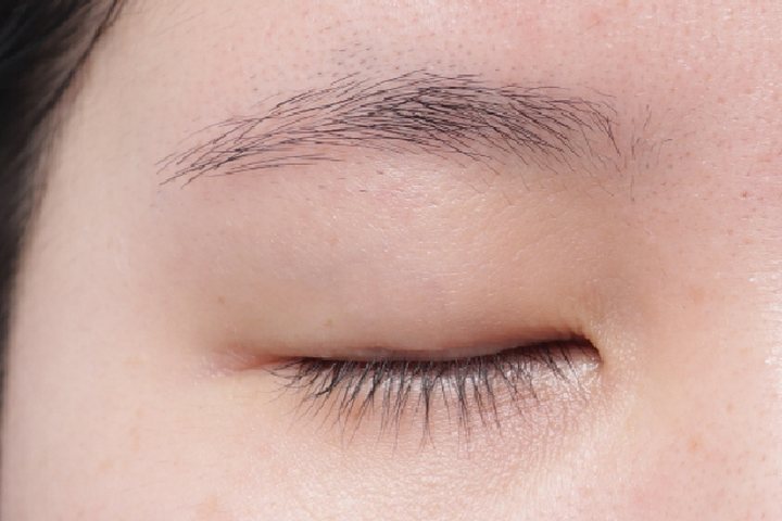 Closed eyelid before natural adhesion double eyelid surgery