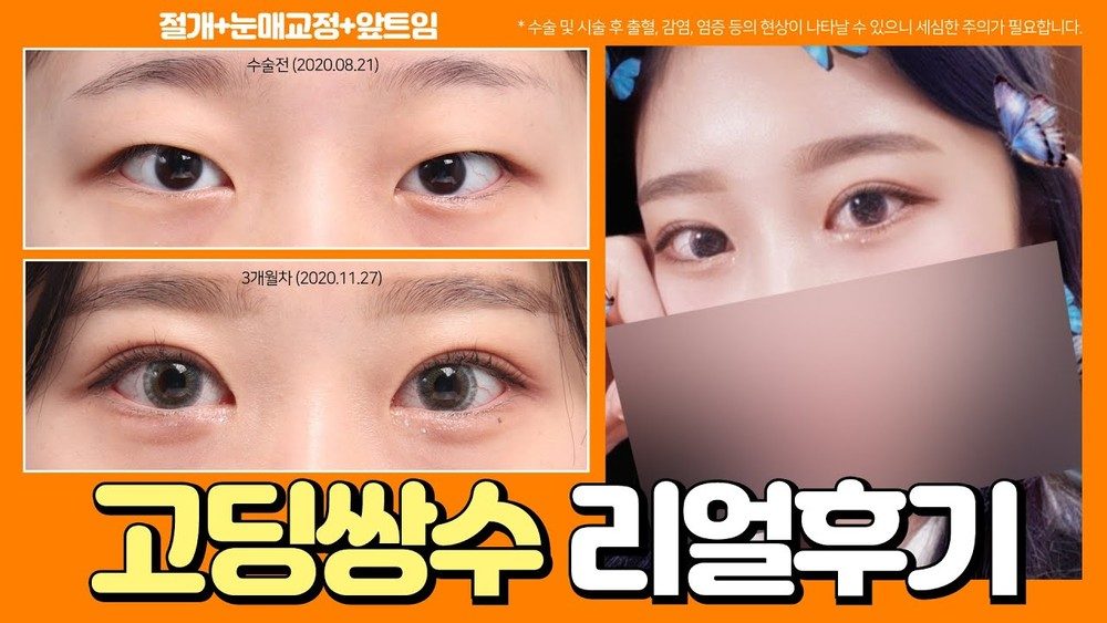 4seasonsTV 영상 썸네일 - 고딩쌍수 리얼후기, 절개+눈매교정+앞트임, 수술전(2020.08.21)과 3개월차(2020.11.27) 눈 비교