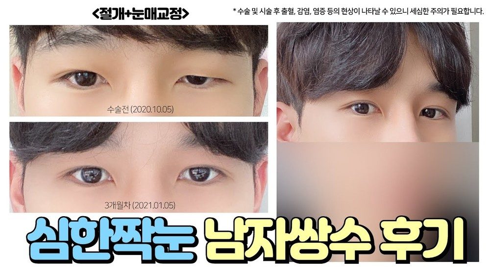 4seasonsTV 영상 썸네일 - 심한짝눈 남자쌍수 후기, 절개+눈매교정, 수술전(2020.10.05)과 3개월차(2021.01.05) 눈 비교