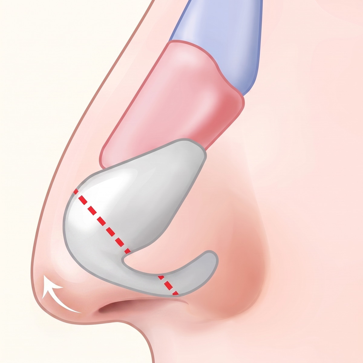 Cross-section diagram with the alar cartilage rotated upward, lifting the nasal tip