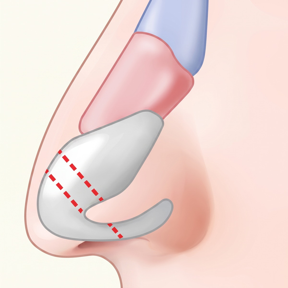 Cross-section diagram of the alar cartilage drooping downward