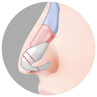 Cross-section diagram marking the drooping alar cartilage and the incision line