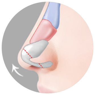 Cross-section diagram with the alar cartilage rotated upward, lifting the nasal tip