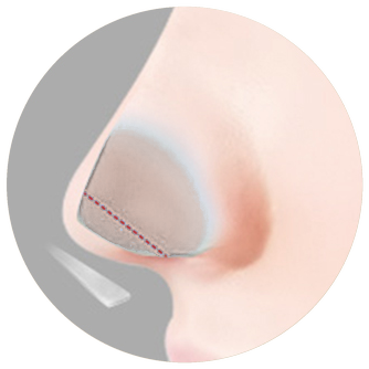 Cross-section diagram marking the septal cartilage that has grown long downward and the resection line