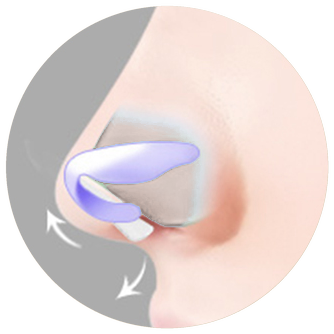 Cross-section diagram showing the nasal tip rotated after part of the end of the septal cartilage is trimmed