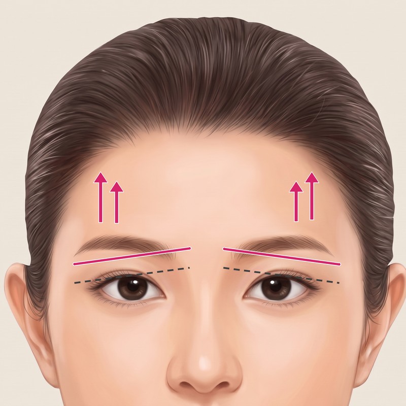 ภาพประกอบใบหน้าแสดงเปลือกตาที่หย่อนคล้อยถูกยกขึ้นจนดวงตาดูสดใสโปร่งขึ้น ด้วยลูกศรและเส้น