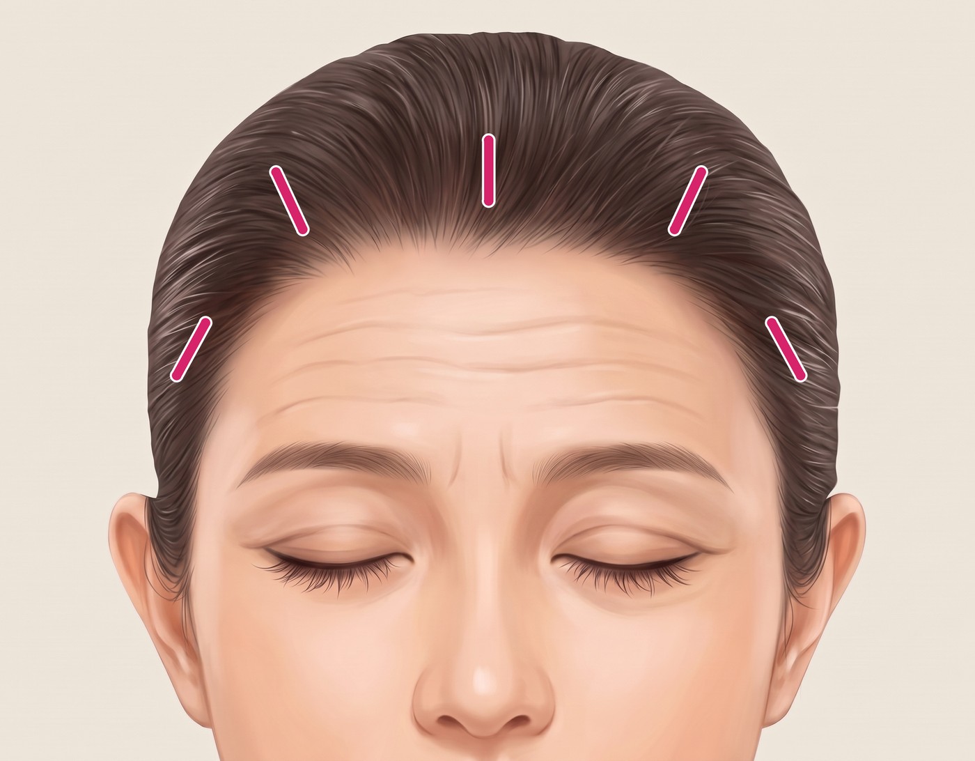 ภาพประกอบหน้าผากแสดงตำแหน่งแผลเล็ก 5 จุดด้านในแนวไรผม
