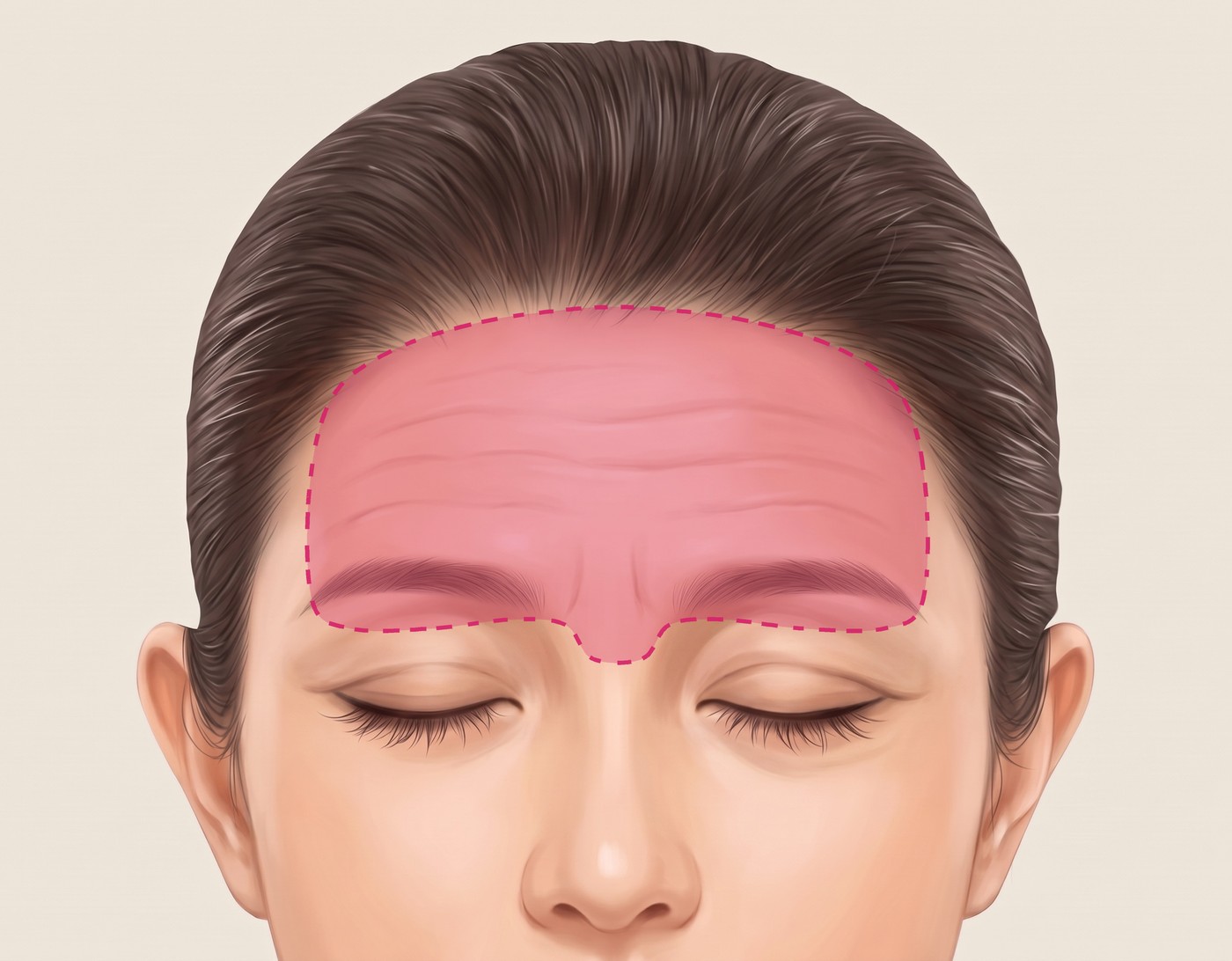 ภาพประกอบหน้าผากแสดงขอบเขตการแยกชั้นเนื้อเยื่อตั้งแต่หน้าผากถึงใต้คิ้ว