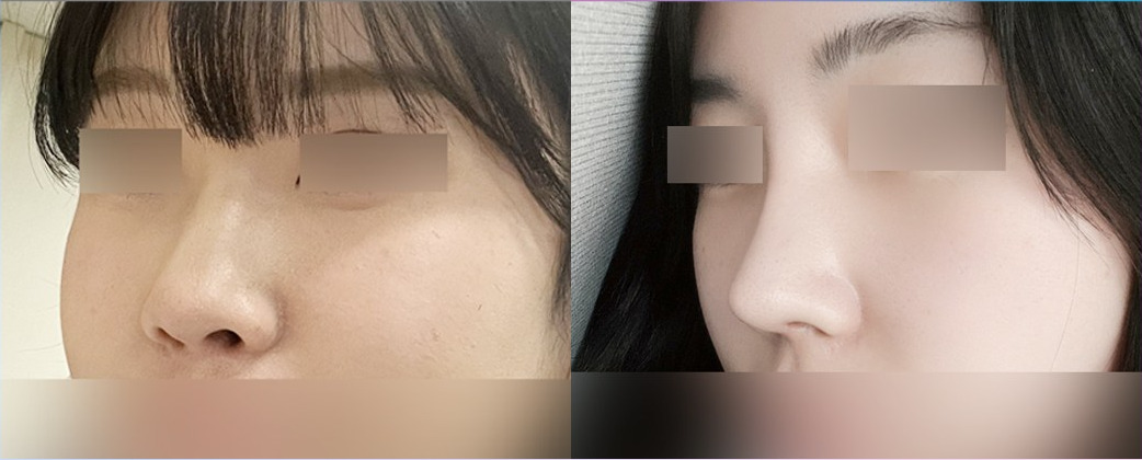 코성형 전(왼쪽)과 1개월 후(오른쪽)의 옆모습 코 사진