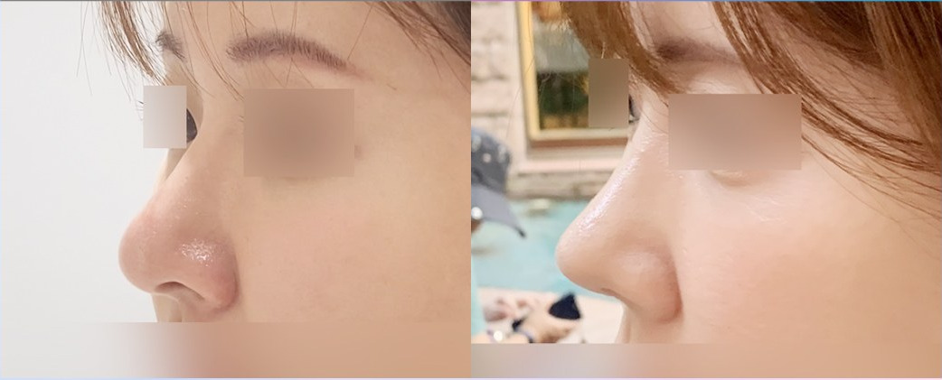 코재수술 전(왼쪽)과 3주 후(오른쪽)의 옆모습 코 사진