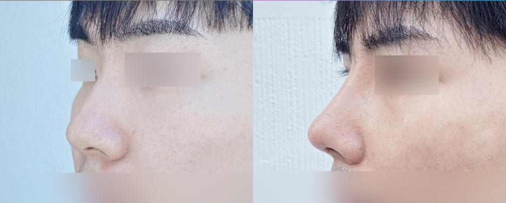 코성형 전(왼쪽)과 3주 후(오른쪽)의 옆모습 코 사진