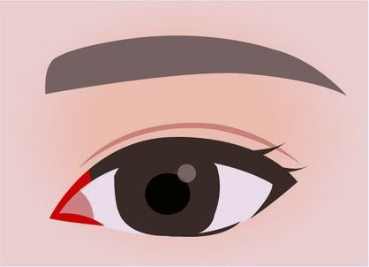 رسم توضيحي لمشكلة ندبة توسيع الزاوية الداخلية، مع بقاء ندبة شق حمراء عند الزاوية الداخلية للعين