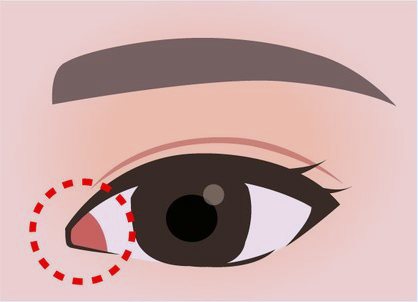 Diagram masalah bentuk epikantoplasti dengan daging merah di sudut dalam mata yang menonjol