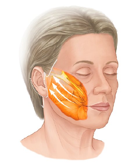 耳まわりの切開線と、SMAS層を上方へ引き上げる方向を示した横顔のイラスト