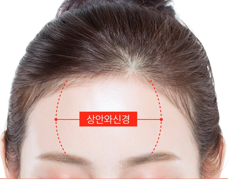 이마 사진 위에 상안와신경이 지나가는 범위를 붉은 점선과 라벨로 표시한 도해