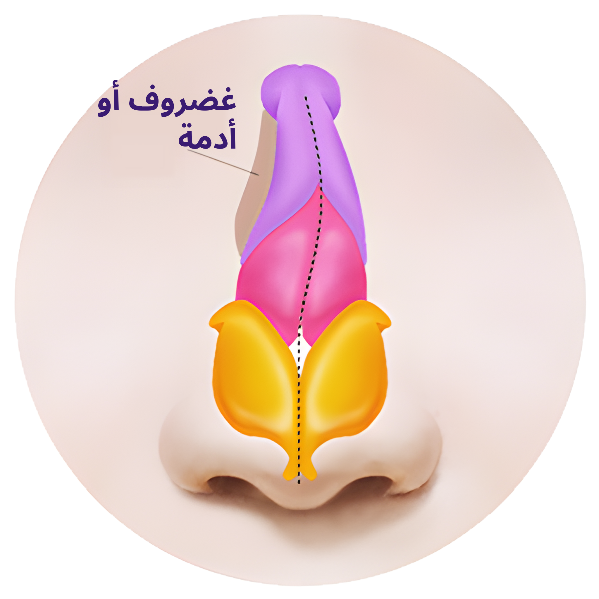 رسم توضيحي لمقطع أمامي لأنف طُعِّمت منطقته الغائرة بغضروف أو أدمة لملئها