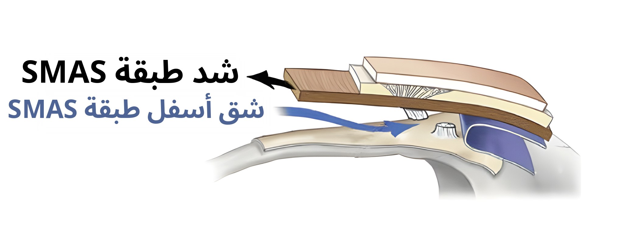مقطع توضيحي عند الشد حتى طبقة SMAS — كُتب على السهم «شد طبقة SMAS»، وعلى السهم الأزرق «شق أسفل طبقة SMAS»