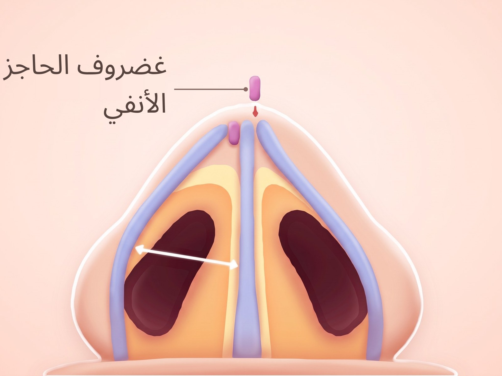 رسم توضيحي لداخل الأنف من الأسفل بعد إدخال طُعم من غضروف الحاجز الأنفي