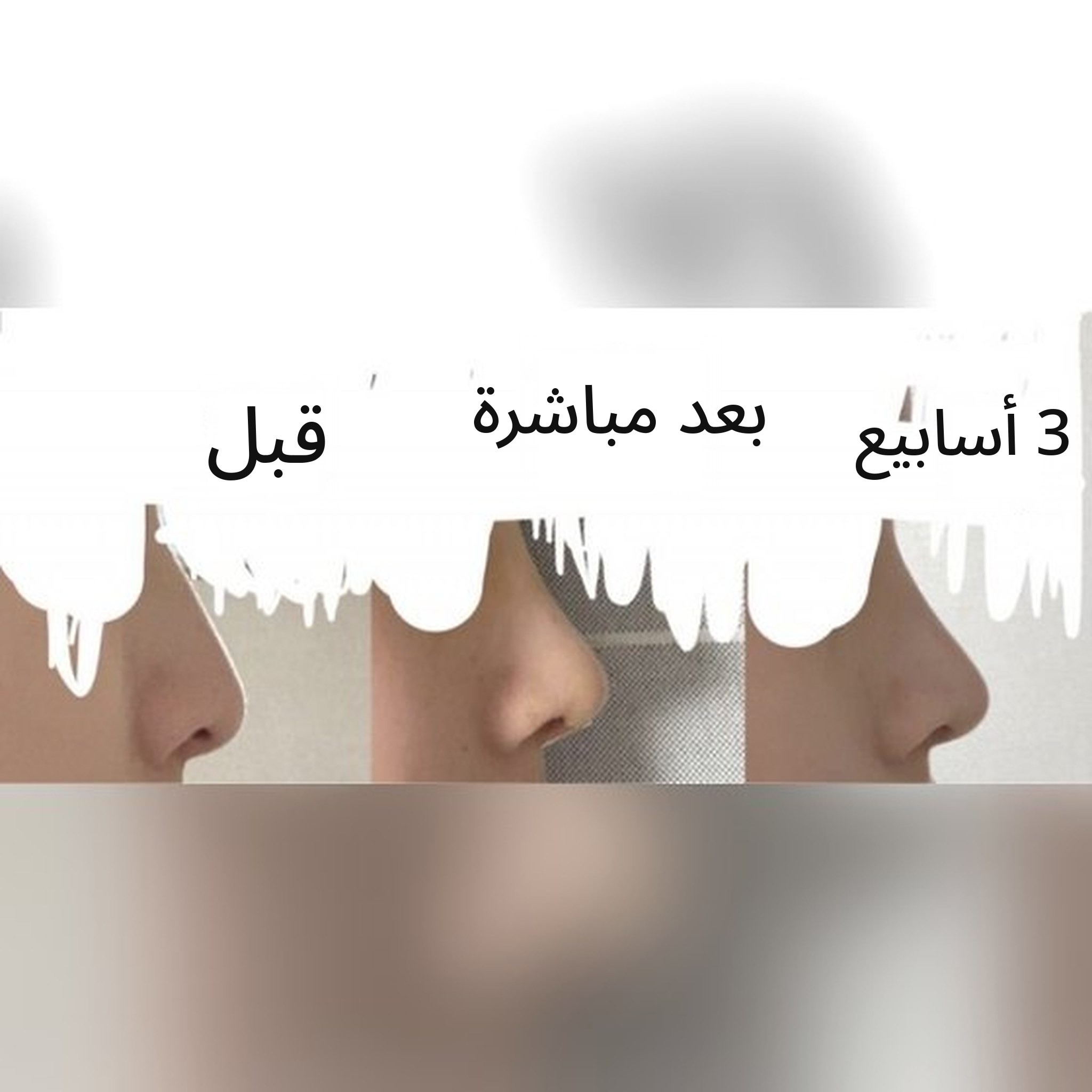 صورة مصغرة لمنشور تجربة جراحة الأنف — أنصح بجراحة الأنف عند الدكتور Jegal Jeong⁠-⁠jae!!!^-^