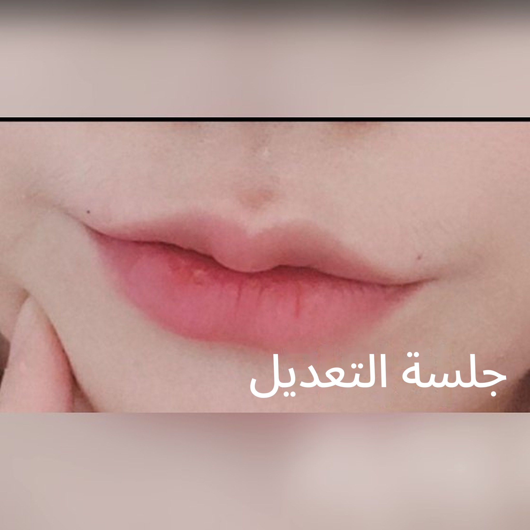 صورة مصغرة لمنشور تجربة الإجراءات التجميلية غير الجراحية — يبدو أنه أفضل مكان لحقن فيلر الشفاه!!