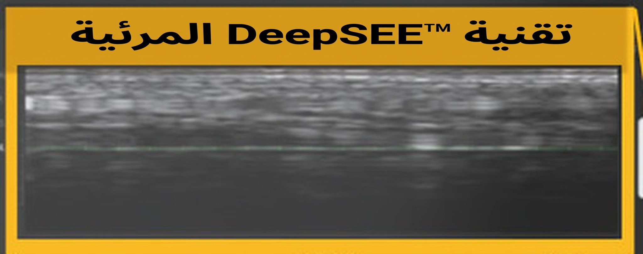 إطار DeepSEE التوضيحي على شاشة Ultherapy PRIME — مقطع فوق صوتي لما تحت الجلد في الوقت الفعلي