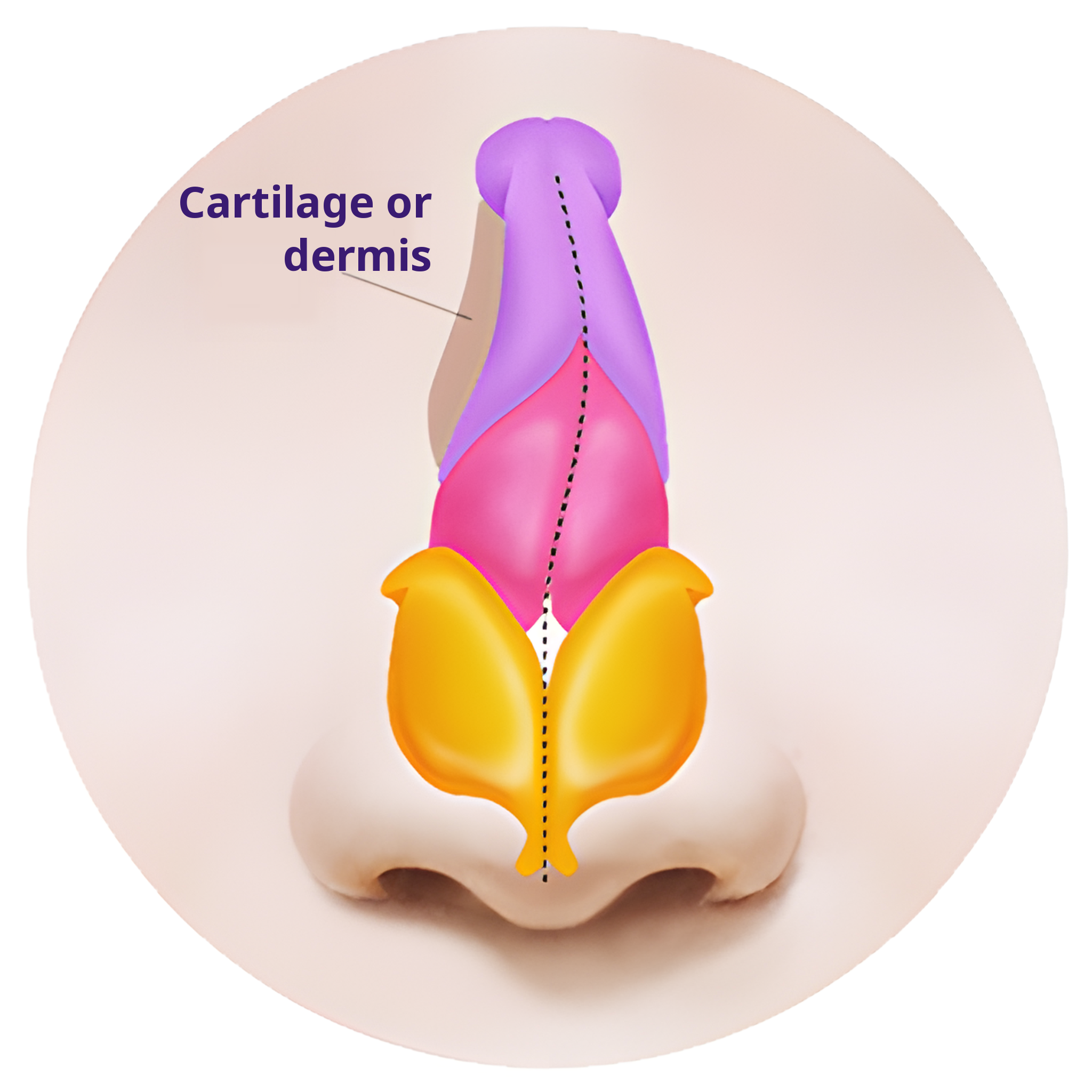 Front cross-section illustration of a nose with cartilage or dermis grafted into the indented area