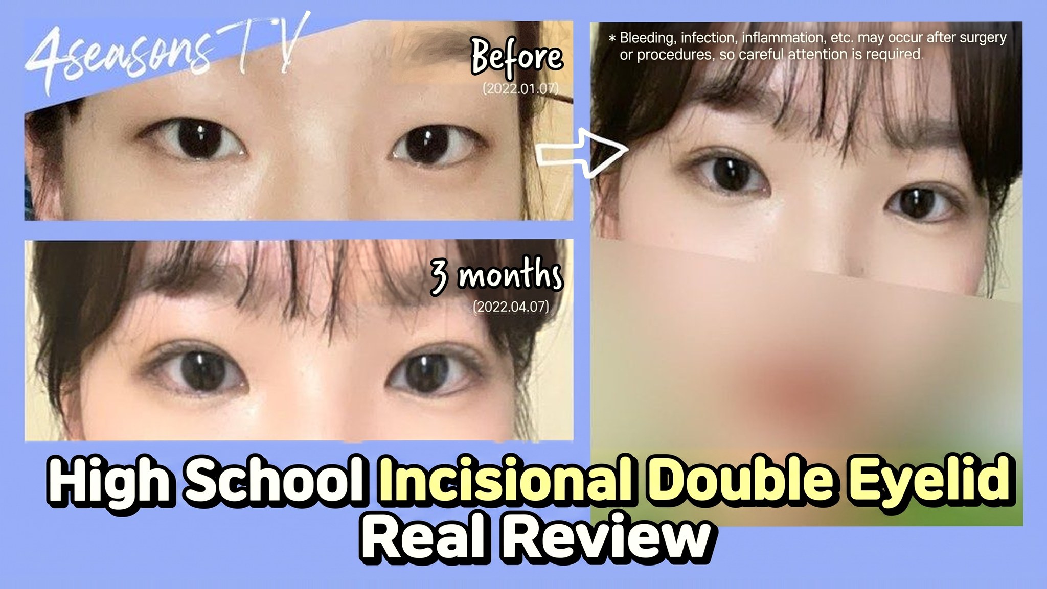 4seasonsTV video thumbnail - High school student incisional double eyelid real review, comparison of eyes before surgery (2022.01.07) and at 3 months (2022.04.07)