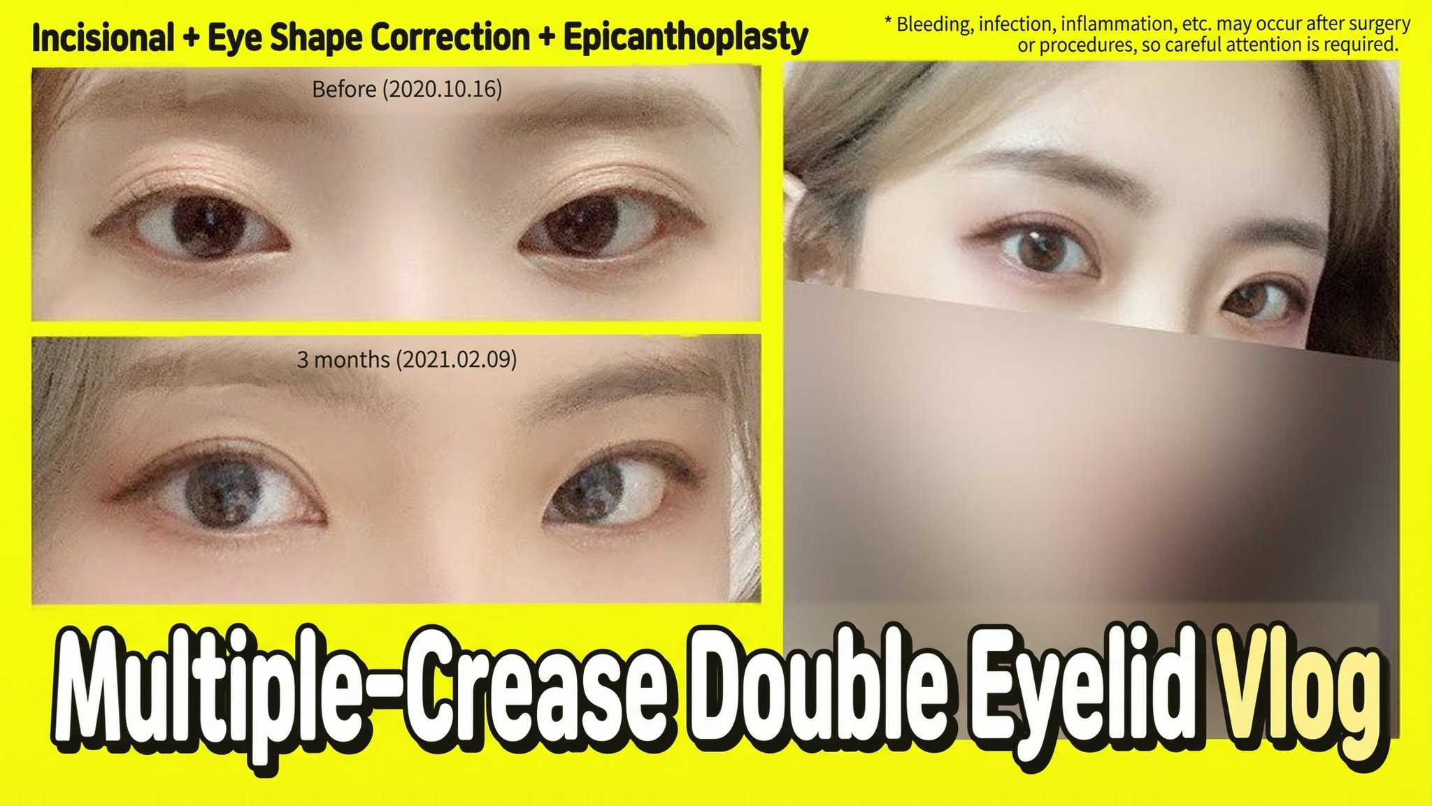 4seasonsTV video thumbnail - Multiple-crease double eyelid vlog, incisional + ptosis correction + medial epicanthoplasty, comparison of eyes before surgery (2020.10.16) and at 3 months (2021.02.09)