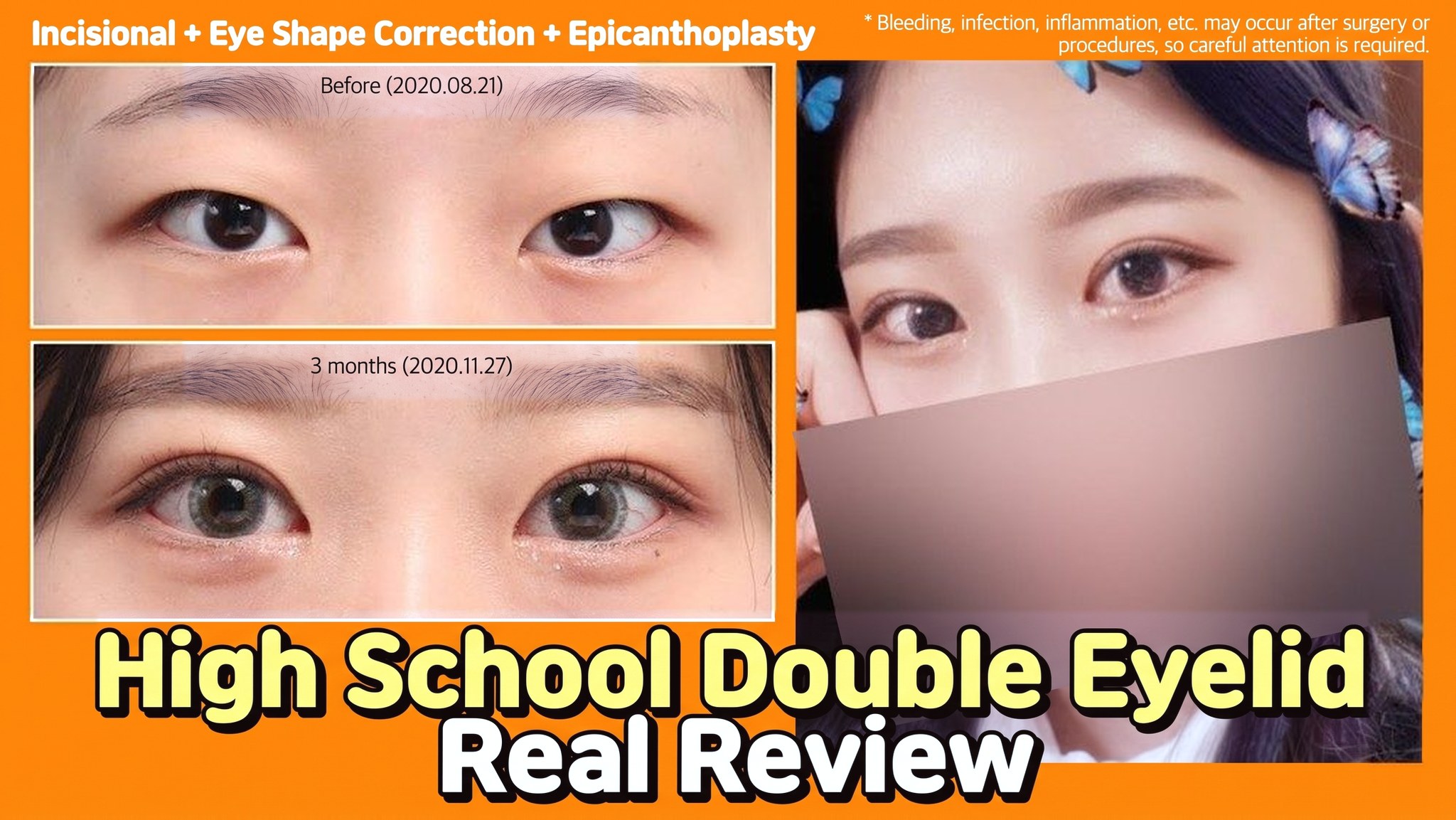 4seasonsTV video thumbnail - High school student double eyelid real review, incisional + ptosis correction + medial epicanthoplasty, comparison of eyes before surgery (2020.08.21) and at 3 months (2020.11.27)