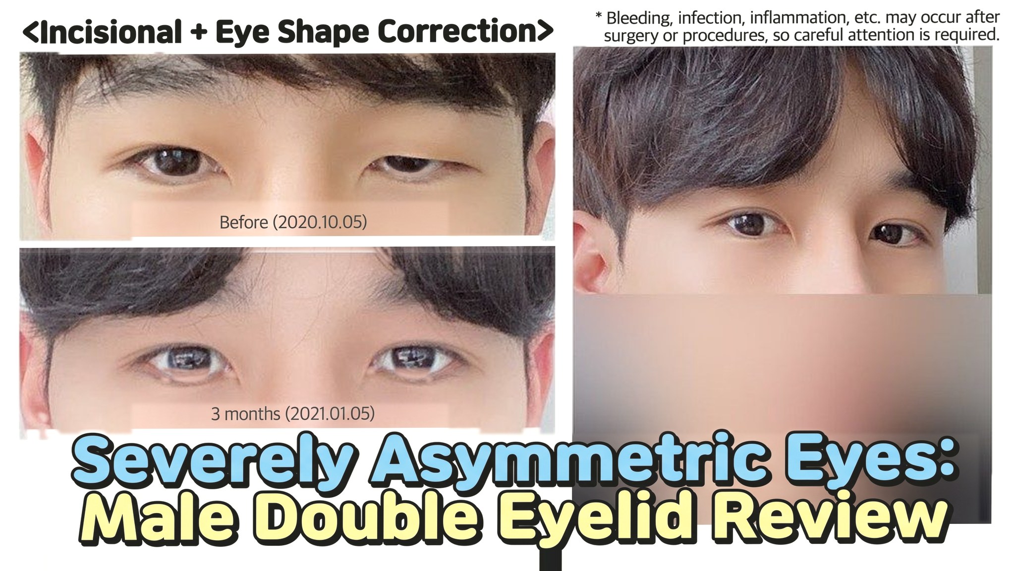 4seasonsTV video thumbnail - Male double eyelid review for severely asymmetric eyes, incisional + ptosis correction, comparison of eyes before surgery (2020.10.05) and at 3 months (2021.01.05)