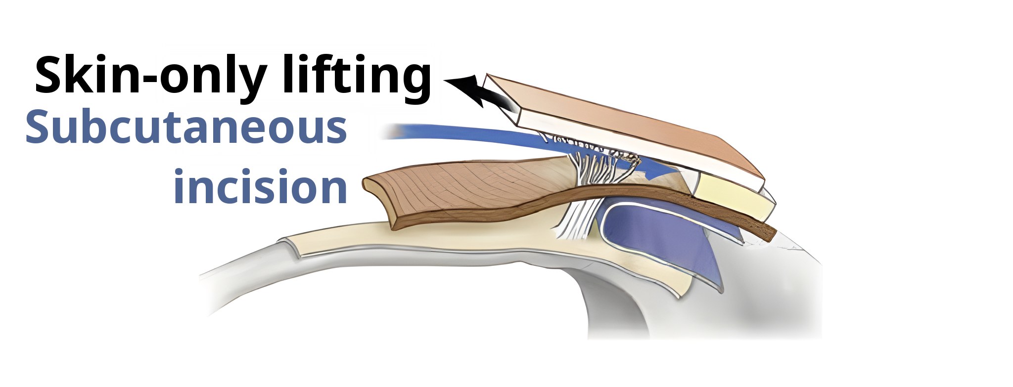 Cross-section diagram of lifting only the skin — the arrow is labeled ‘Skin-only lifting’ and the blue arrow ‘Subcutaneous incision’