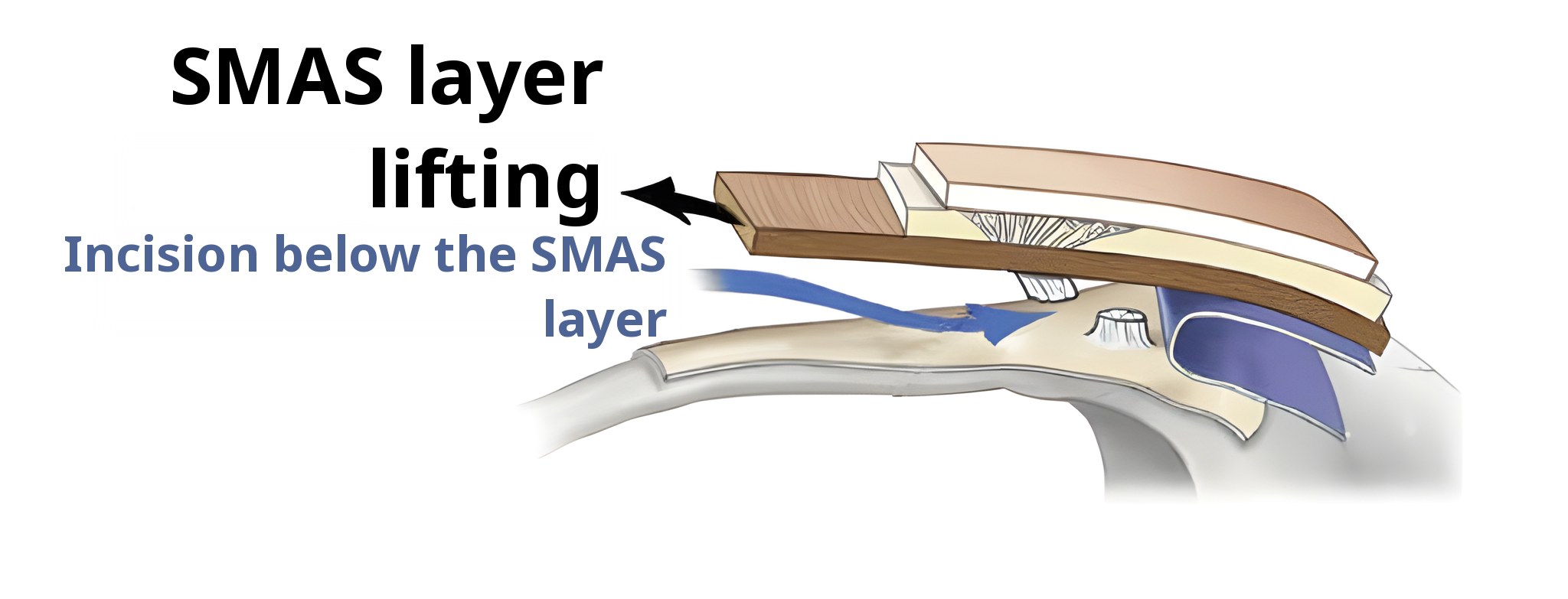 Cross-section diagram of lifting up to the SMAS layer — the arrow is labeled ‘SMAS layer lifting’ and the blue arrow ‘Incision below the SMAS layer’
