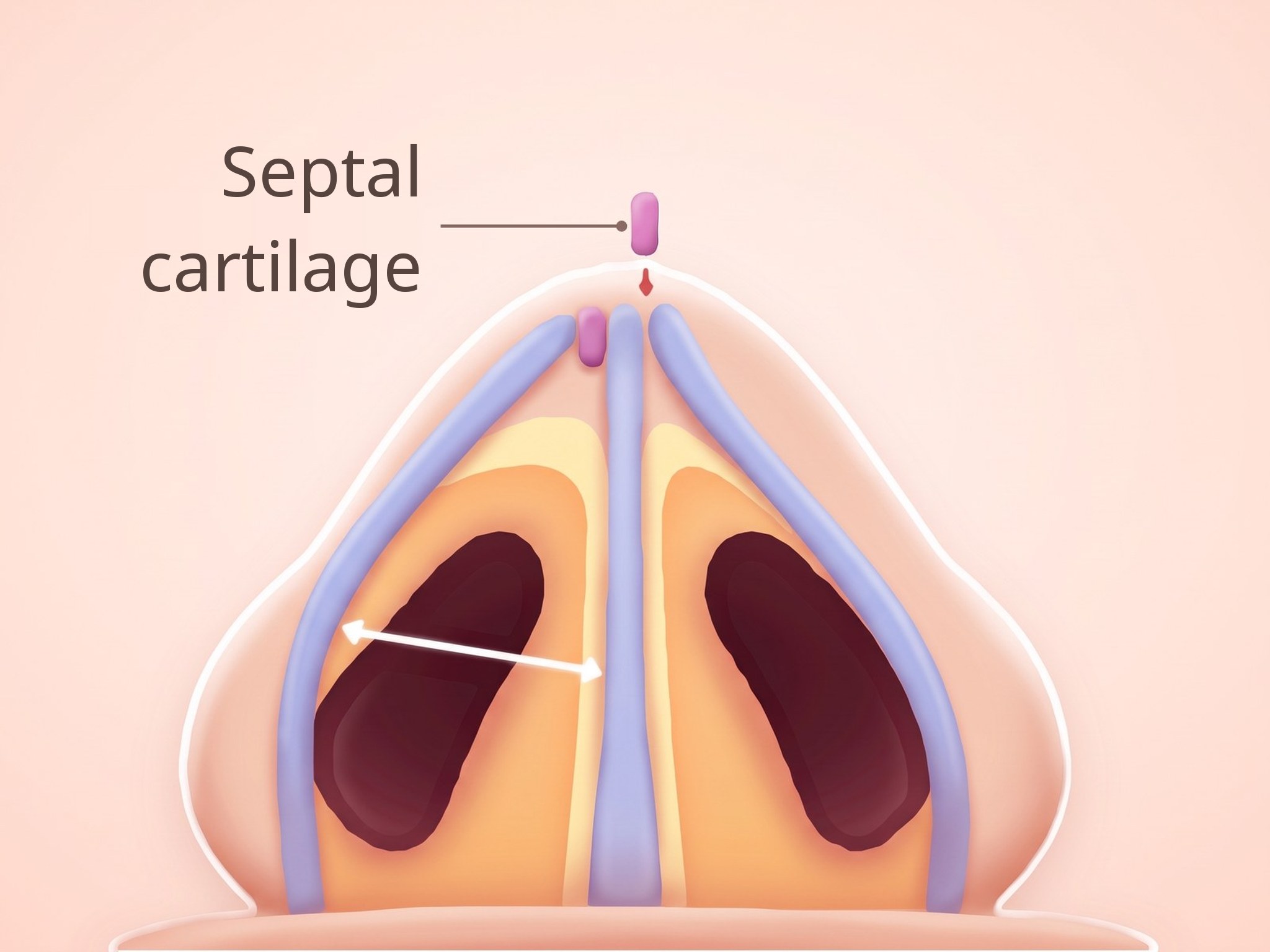 Illustration of the inside of the nose with a septal cartilage graft inserted, viewed from below
