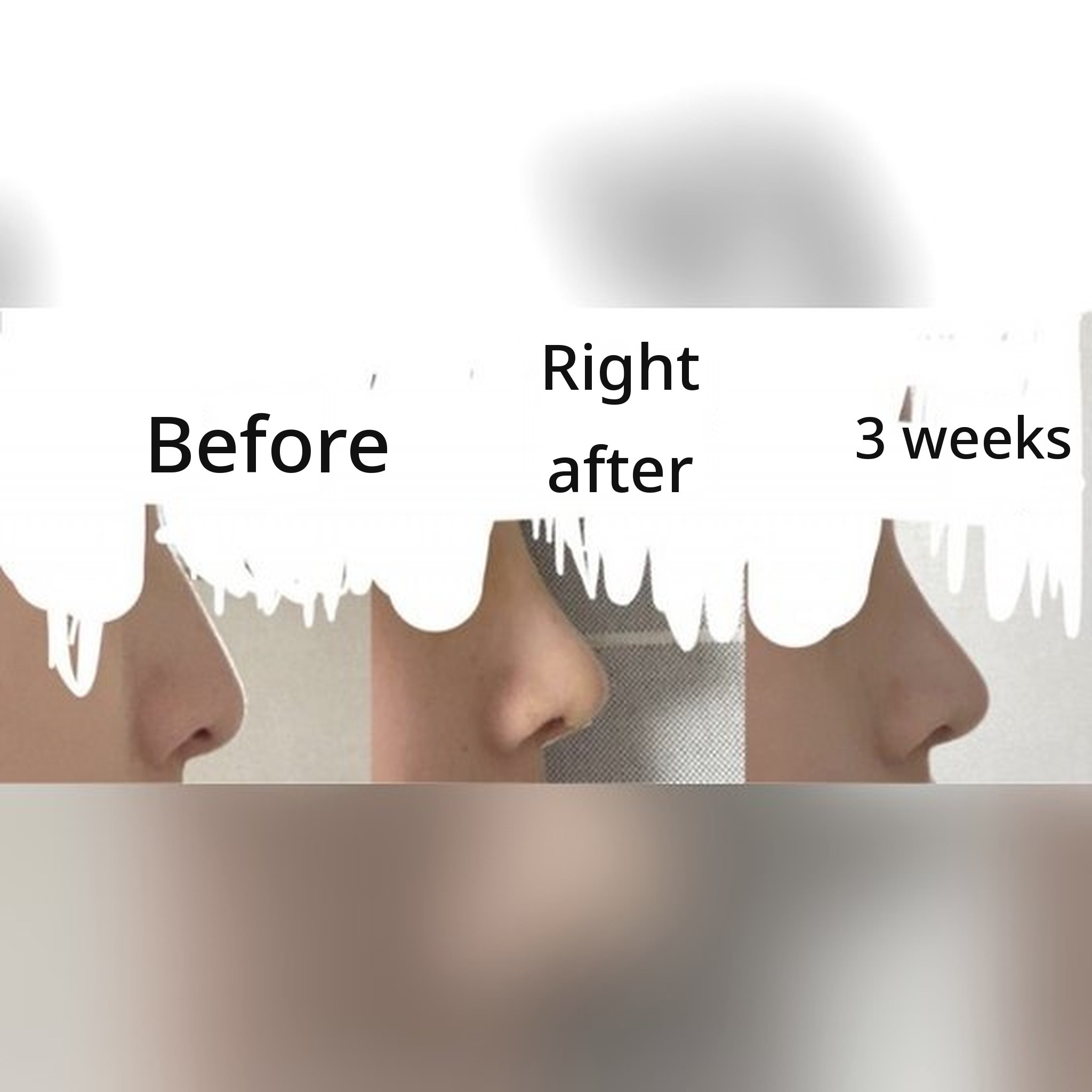 Rhinoplasty review post thumbnail — I highly recommend Dr. Jegal Jeong⁠-⁠jae for rhinoplasty!!!^-^