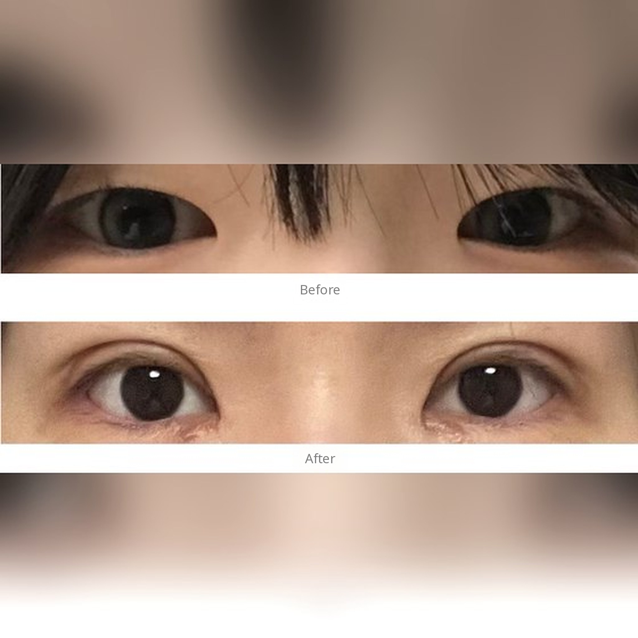 Eye surgery review post thumbnail — Double eyelid surgery review, Four Seasons in Busan