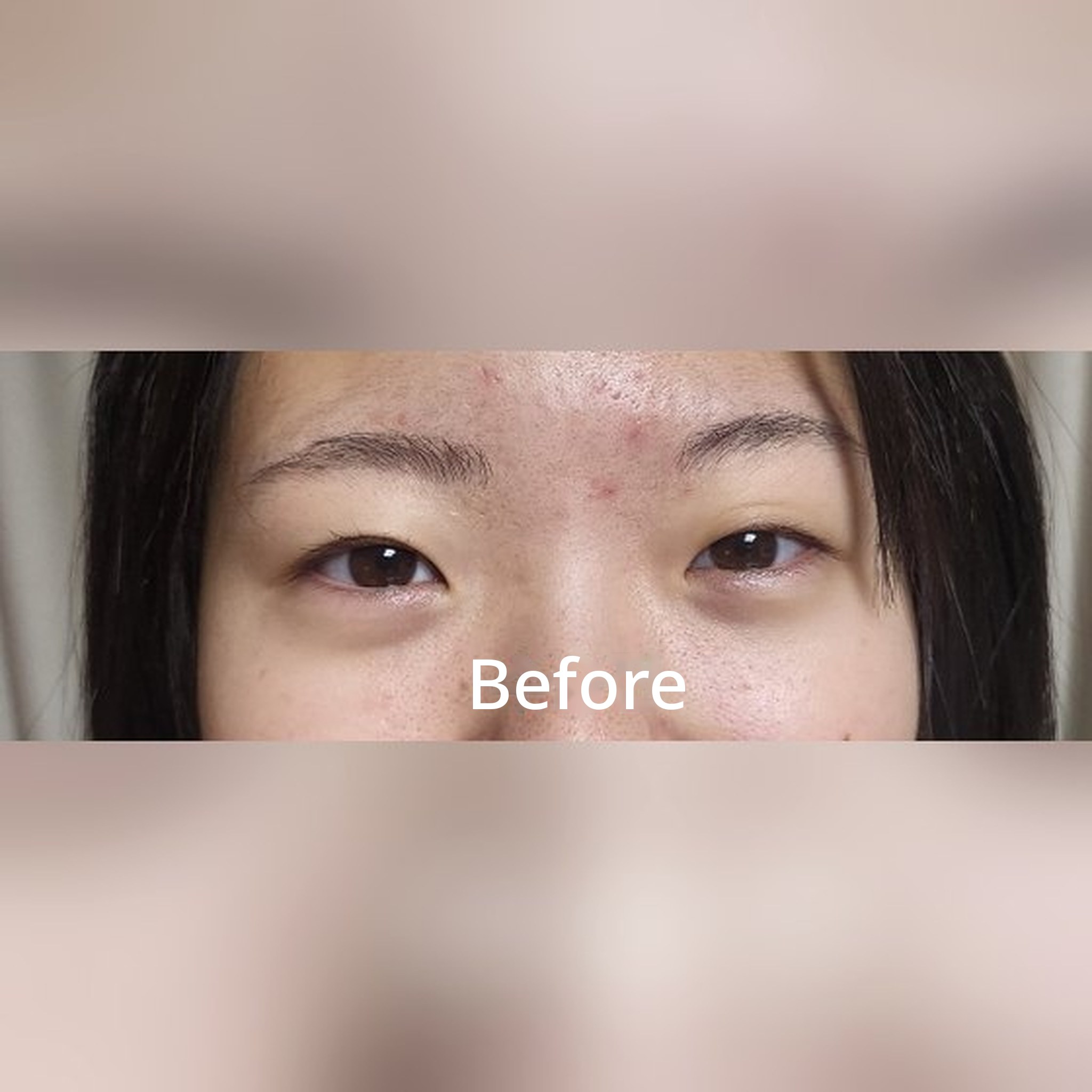 Eye surgery review post thumbnail — Leaving a double eyelid surgery review for my high-school daughter~~