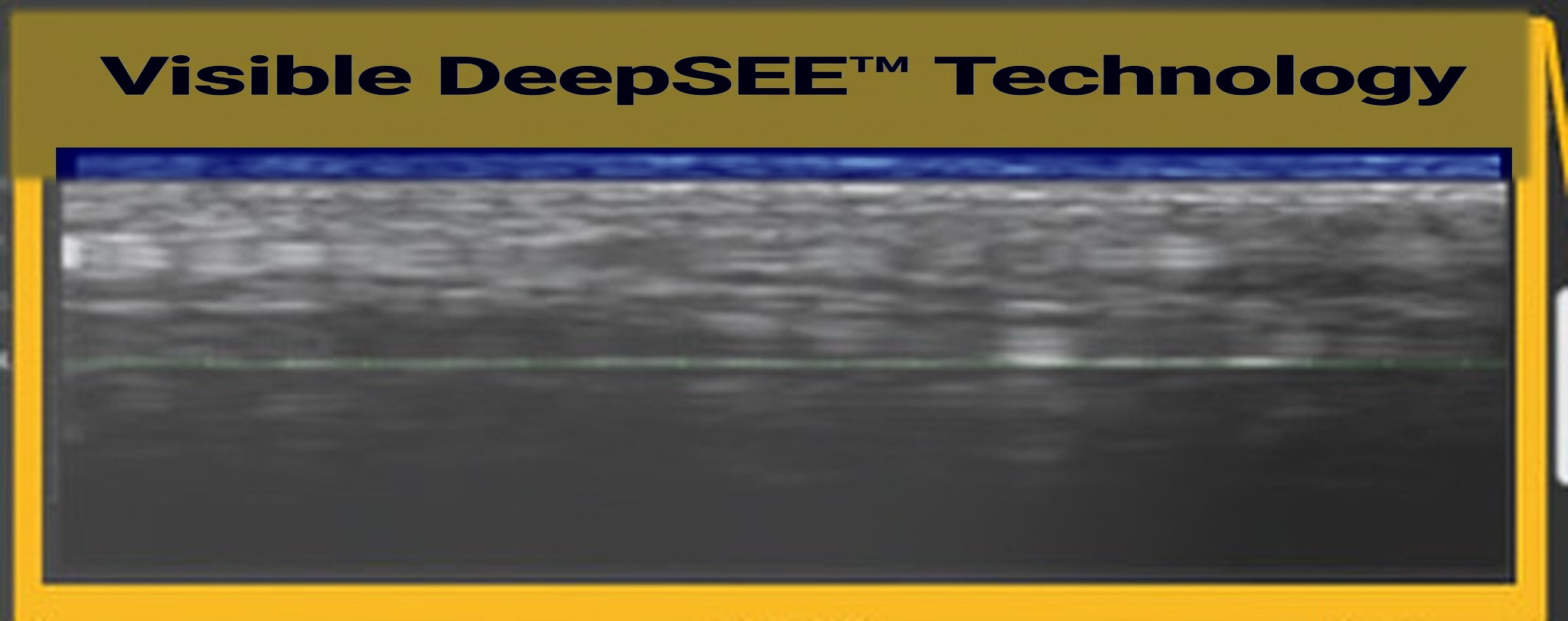 DeepSEE callout on the Ultherapy PRIME screen — real-time ultrasound cross-section of the skin