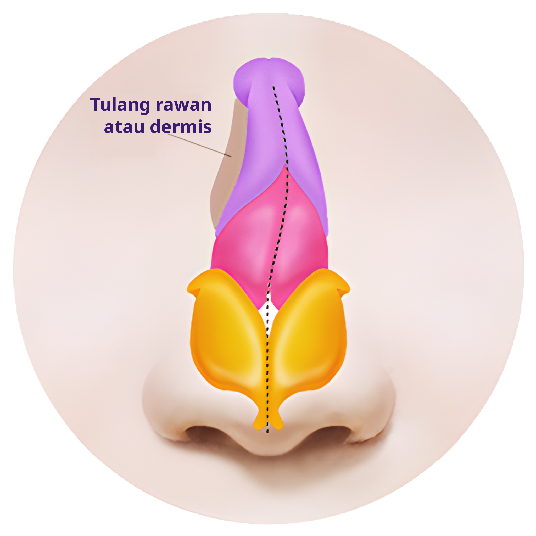 Ilustrasi penampang depan hidung dengan bagian cekung yang diisi cangkok tulang rawan atau dermis
