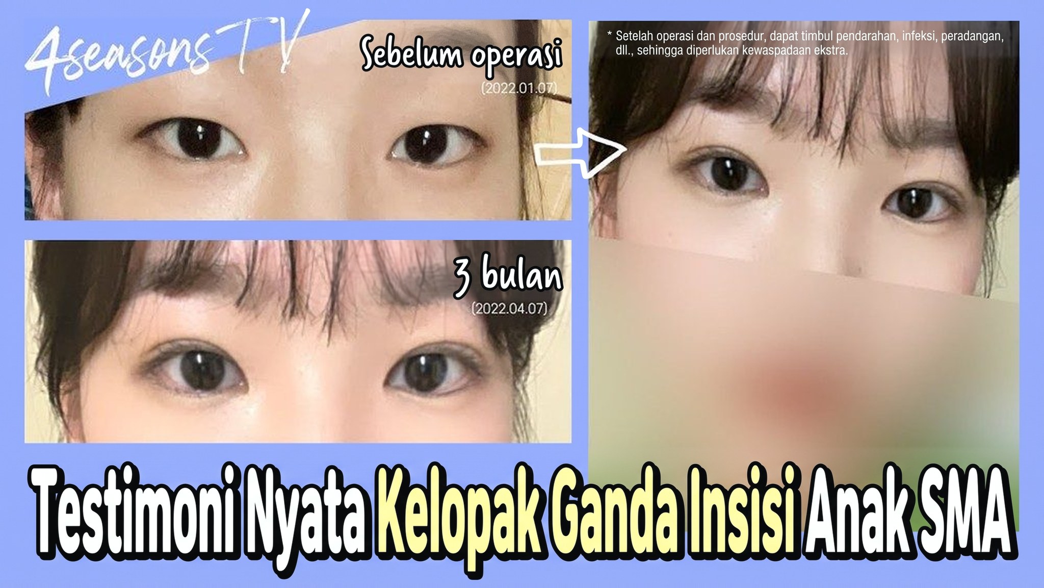 Thumbnail video 4seasonsTV - Testimoni nyata operasi kelopak mata ganda insisi anak SMA, perbandingan mata sebelum operasi (2022.01.07) dan 3 bulan setelahnya (2022.04.07)