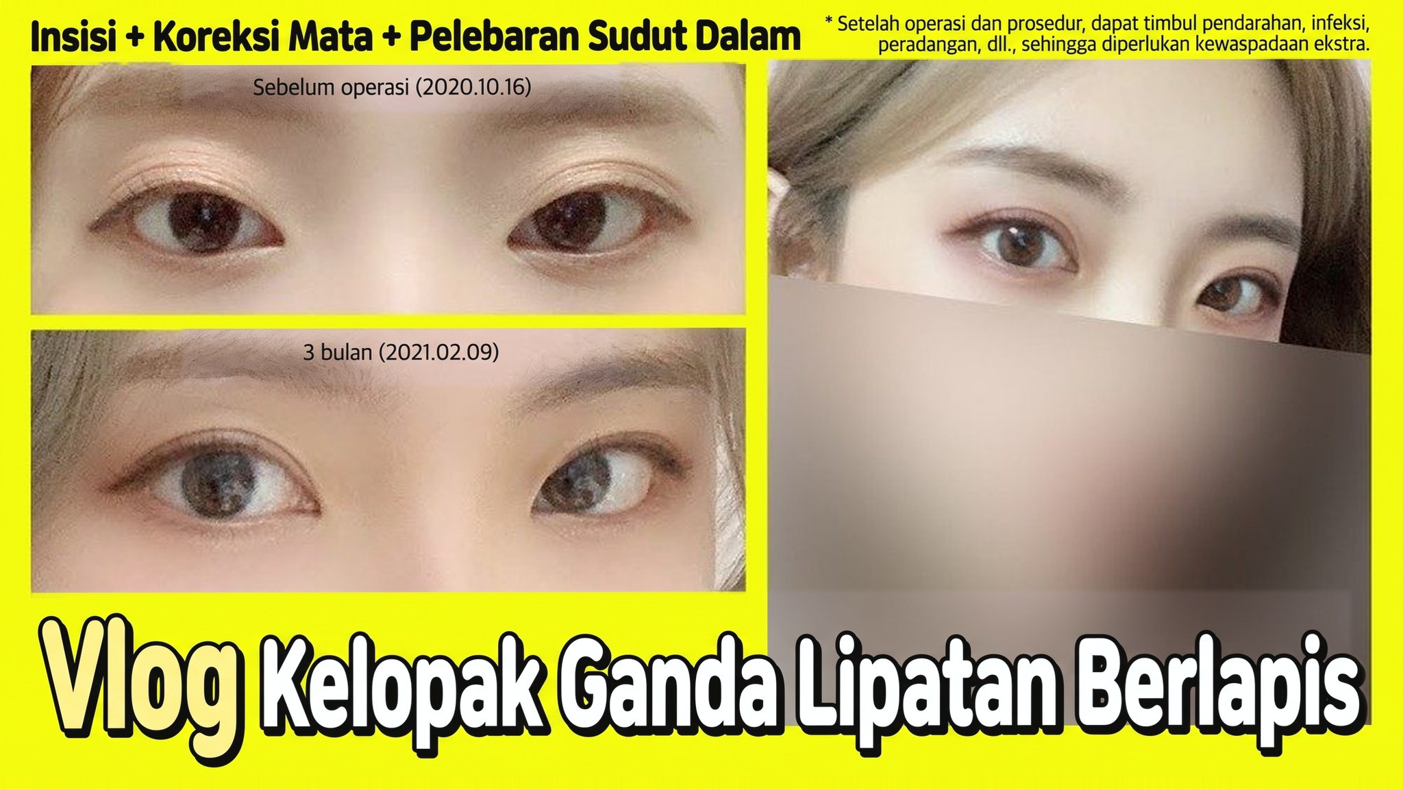 Thumbnail video 4seasonsTV - Vlog operasi kelopak mata ganda dengan lipatan berlapis, insisi + koreksi ptosis + epicanthoplasty, perbandingan mata sebelum operasi (2020.10.16) dan 3 bulan setelahnya (2021.02.09)