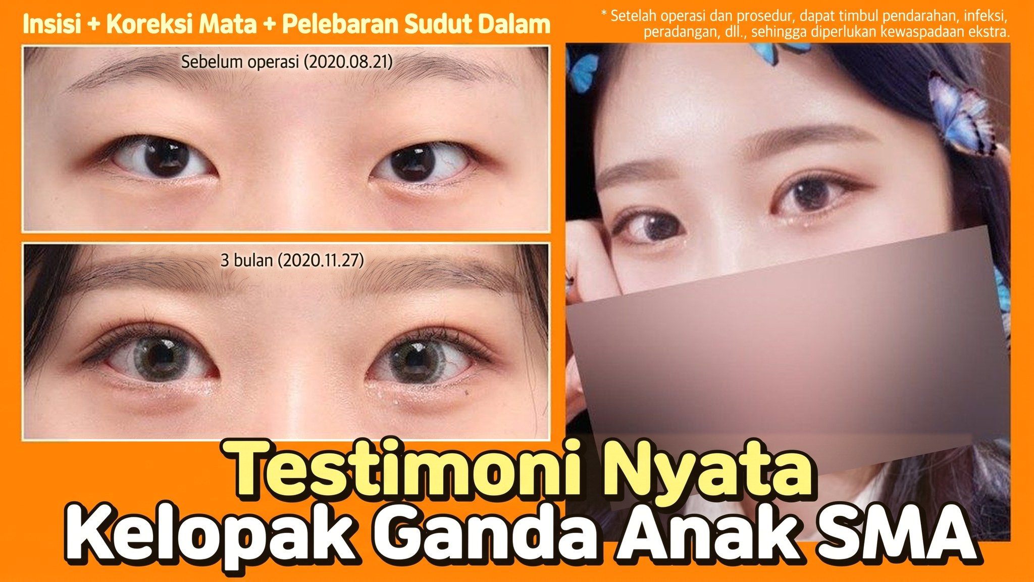 Thumbnail video 4seasonsTV - Testimoni nyata operasi kelopak mata ganda anak SMA, insisi + koreksi ptosis + epicanthoplasty, perbandingan mata sebelum operasi (2020.08.21) dan 3 bulan setelahnya (2020.11.27)