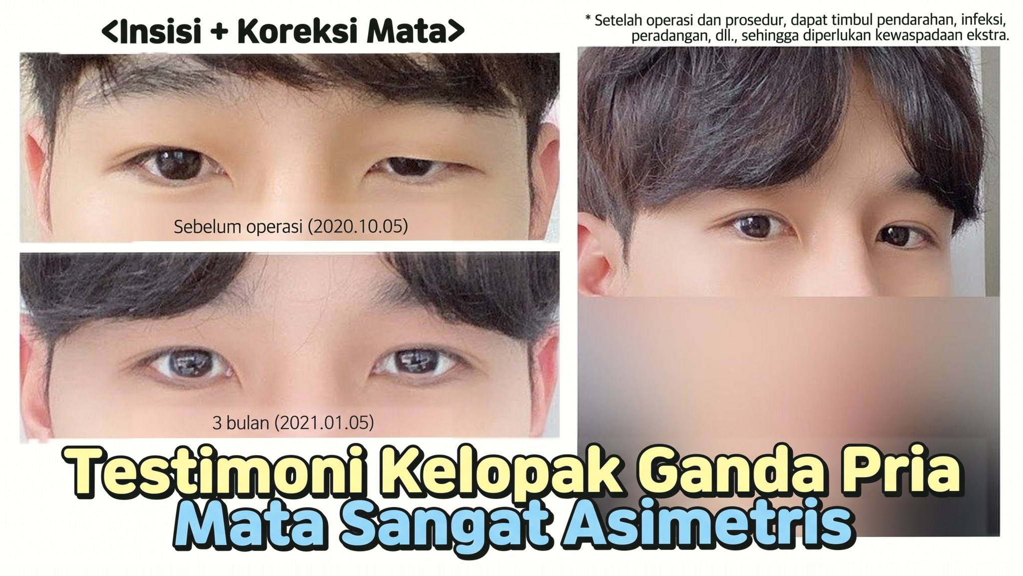 Thumbnail video 4seasonsTV - Testimoni operasi kelopak mata ganda pria dengan mata sangat asimetris, insisi + koreksi ptosis, perbandingan mata sebelum operasi (2020.10.05) dan 3 bulan setelahnya (2021.01.05)
