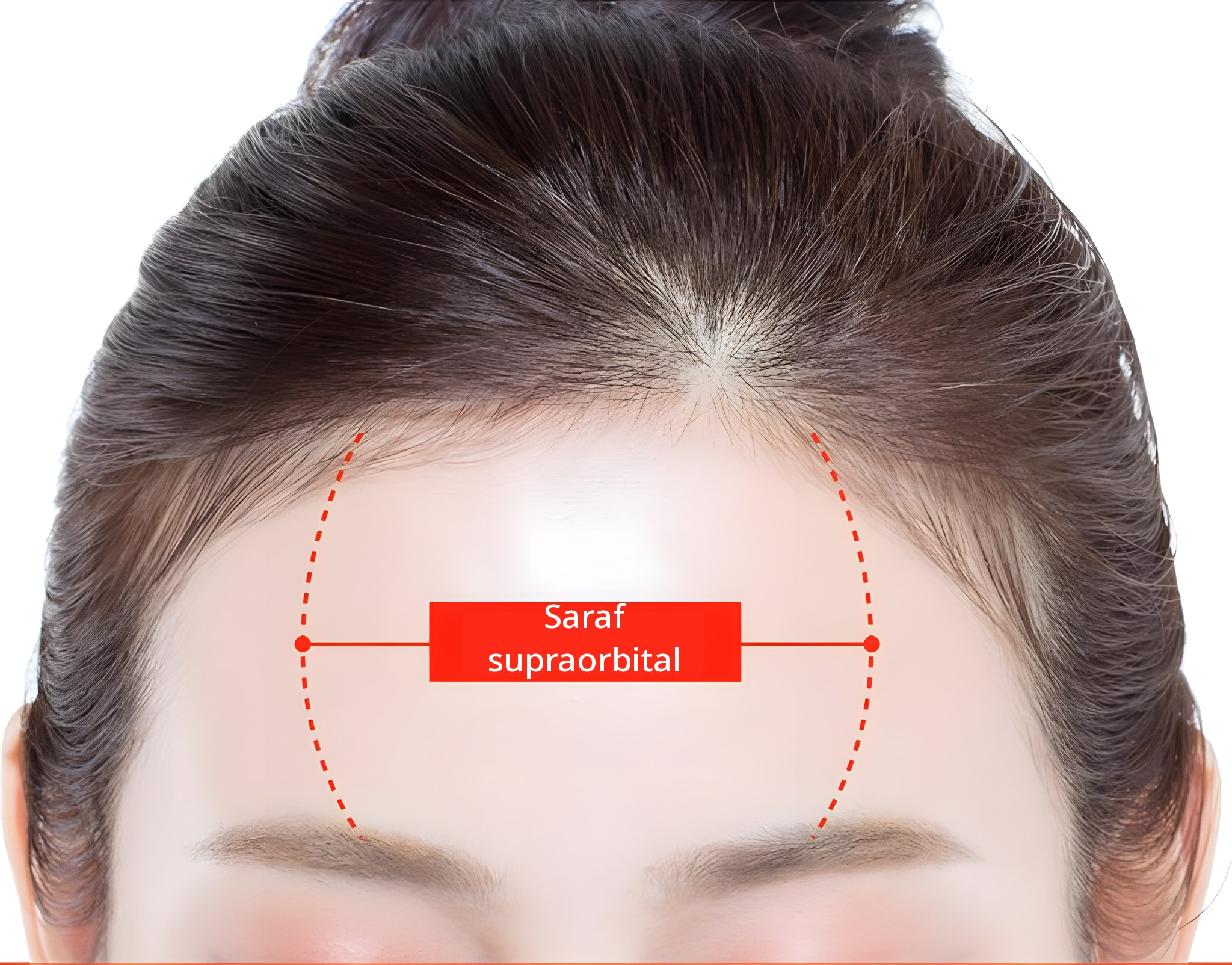 Ilustrasi foto dahi dengan area jalur saraf supraorbital yang ditandai garis putus-putus merah dan label