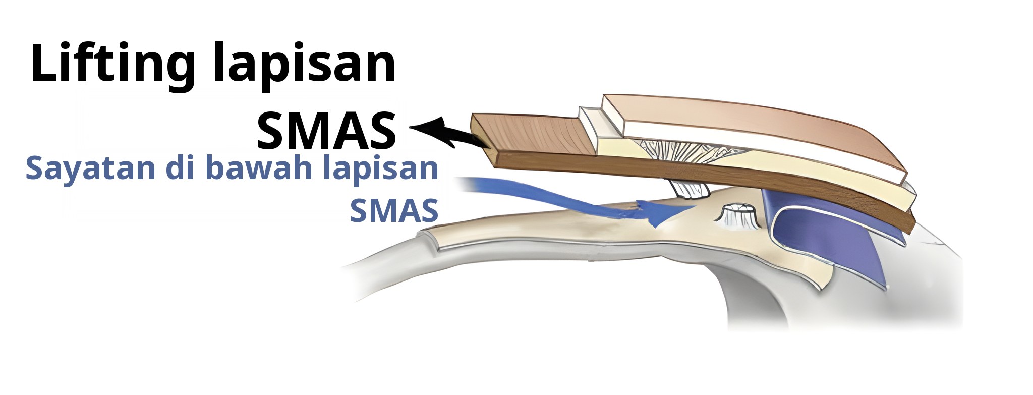 Penampang saat lifting hingga lapisan SMAS — panah berlabel ‘Lifting lapisan SMAS’ dan panah biru berlabel ‘Sayatan di bawah lapisan SMAS’