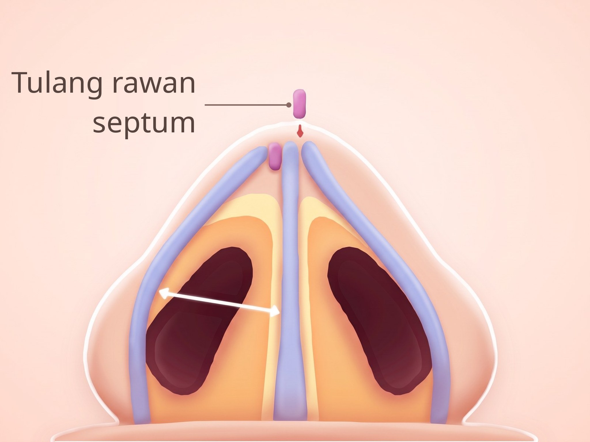 Ilustrasi bagian dalam hidung dengan cangkok tulang rawan septum, dilihat dari bawah