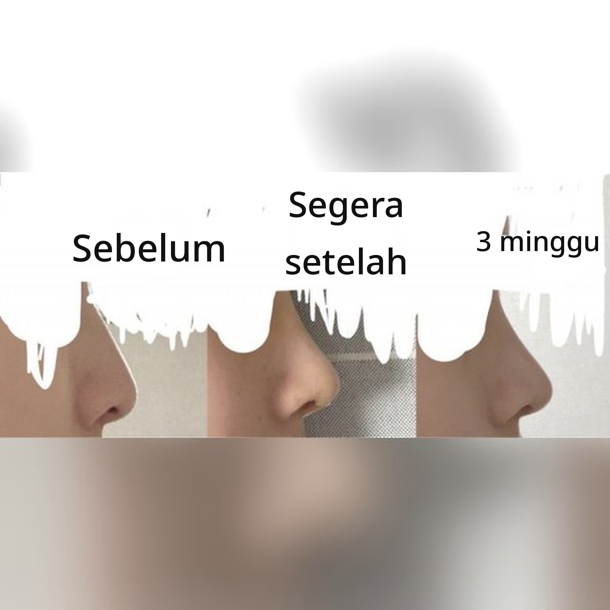 Thumbnail postingan ulasan operasi hidung — Rekomendasi operasi hidung dengan Dr. Jegal Jeong⁠-⁠jae!!!^-^