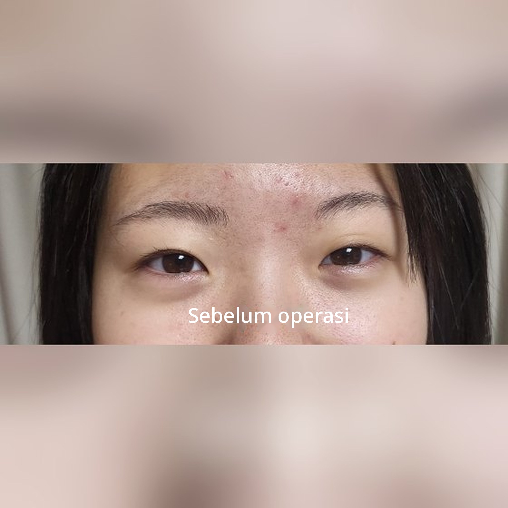 Thumbnail postingan ulasan operasi mata — Saya menulis ulasan operasi kelopak mata ganda putri saya yang masih SMA~~