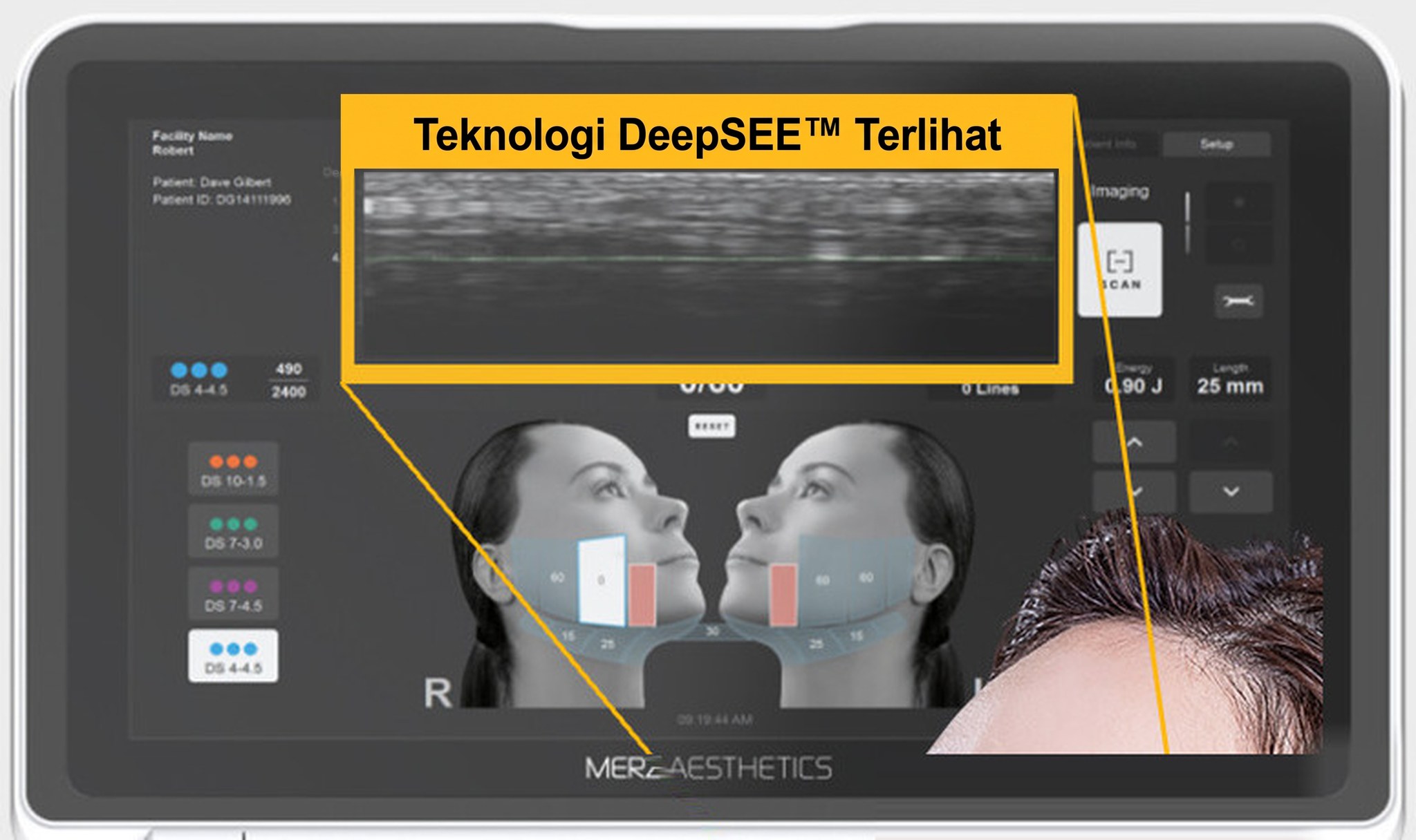 Monitor Ultherapy PRIME — layar perangkat dengan bezel yang terlihat di keempat sisinya